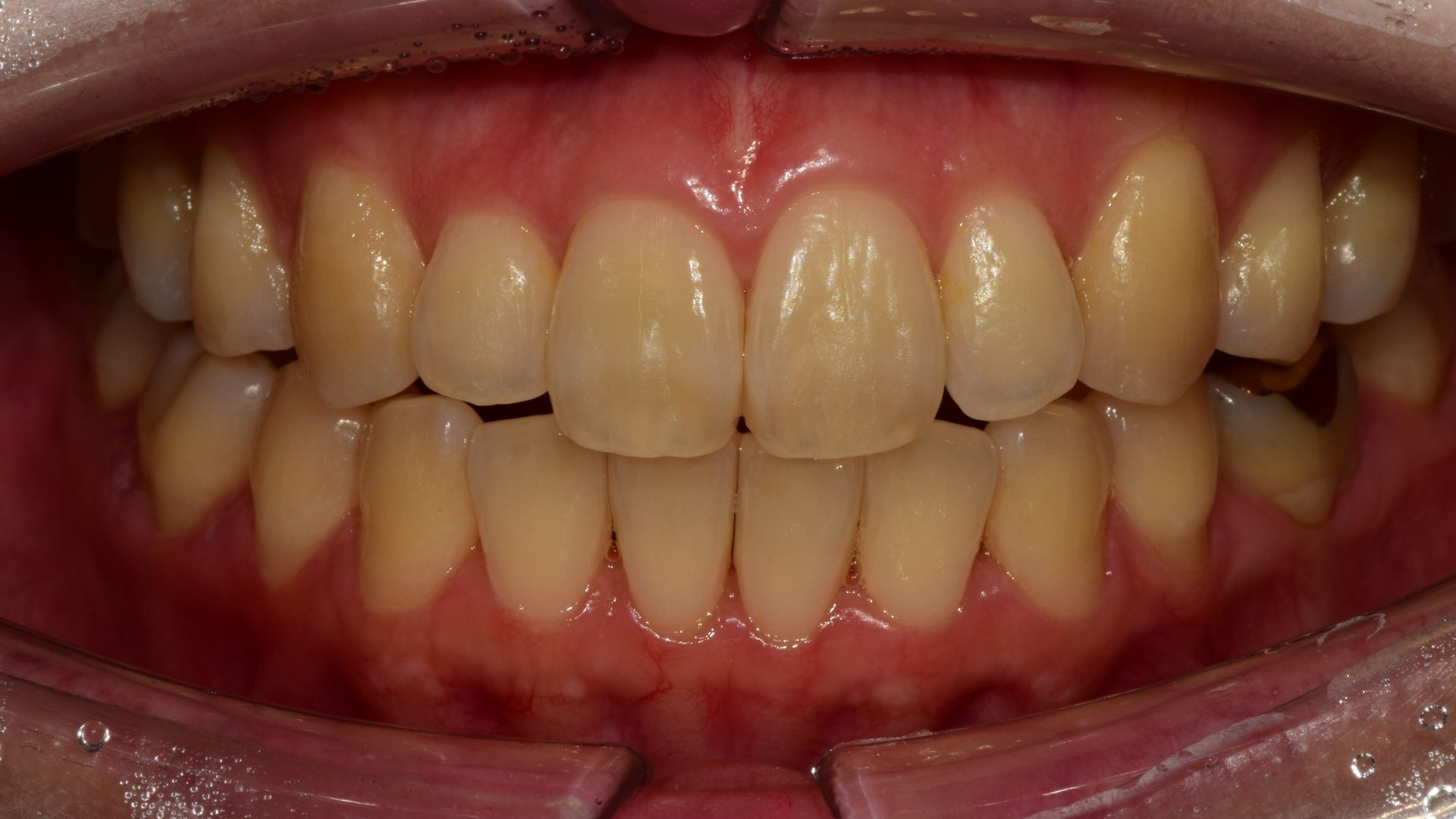 Before