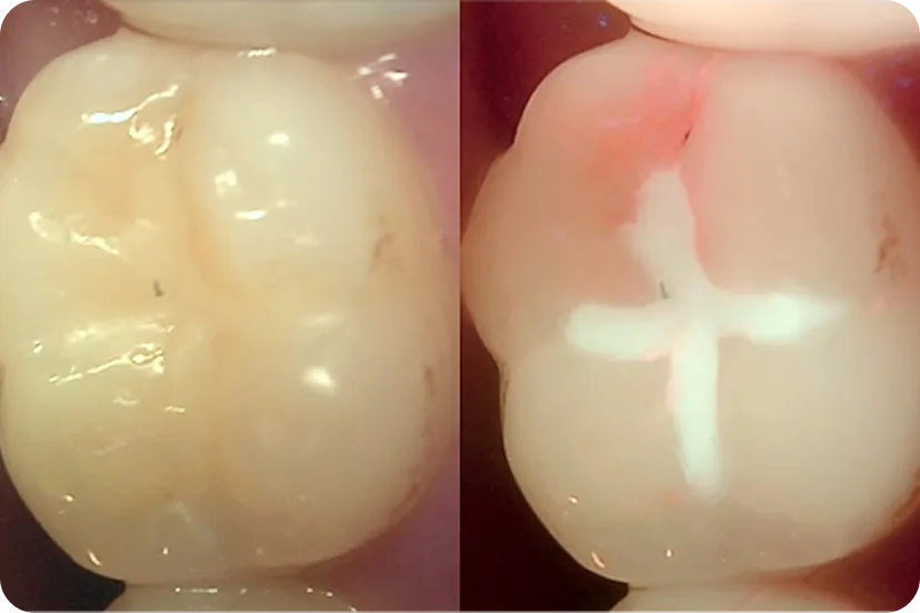 가글마취