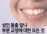 성인 앞니 부분 교정의 모든 것