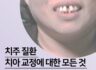 치주질환 치아교정에 대한 모든 것!