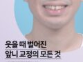 웃을 때 벌어진 앞니 교정의 모든 것