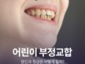 어린이 부정교합 원인과 증상은?