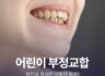 어린이 부정교합 원인과 증상은?