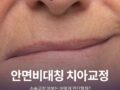 안면비대칭 치아교정 수술교정 여부는 어떻게?