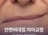 안면비대칭 치아교정 수술교정 여부는 어떻게?