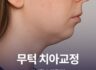무턱 치아교정 개선할 수 있을까?