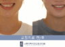 앞니 벌어짐 교정과 왜소치 치료 사례