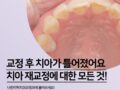 치아 틀어짐 재교정에 대한 모든 것!