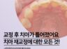 치아 틀어짐 재교정에 대한 모든 것!