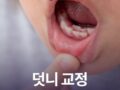 덧니교정 방법과 기간은 얼마나 걸릴까