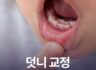 덧니교정 방법과 기간은 얼마나 걸릴까