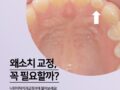 왜소치 교정 꼭 해야할까?