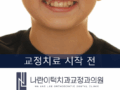 송곳니덧니교정 언제 교정 시작해야 할까?