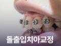 돌출입치아교정 발치 없이도 가능할까?