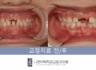 하악전돌(주걱턱) 프리올소 성장 교정 정확히 무엇인가요?