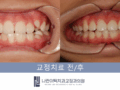 융합치 영구치 1차 교정으로 치열 회복