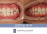 융합치 영구치 1차 교정으로 치열 회복