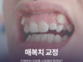 매복치 교정, 언제부터 치료를 시작해야 할까요?