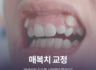 매복치 교정, 언제부터 치료를 시작해야 할까요?