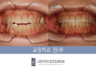 ■앞니 오픈바이트/틈 문제로 고민이신가요?■