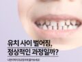 아이 유치 앞니 사이 공간 벌어짐, 정상인가요?
