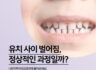 아이 유치 앞니 사이 공간 벌어짐, 정상인가요?