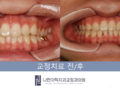 ■교정 중 고무줄 안 끼워도 될까요? 청소년 교정에서 꼭 지켜주셔야 할 협조 포인트!■