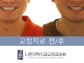 ■ 치아에 부착하는 교정 장치 부담된다면, 인비절라인 투명교정으로 ■