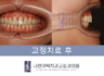 ■ 유지장치 떨어짐 방치 시에는? 인비절라인 부분 교정으로 앞니 틀어짐 개선 CASE ■
