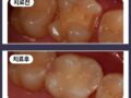 치아사이에 충치가 생겼어요!