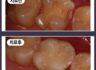 치아사이에 충치가 생겼어요!
