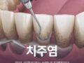 치주염 원인 잇몸치료 어떻게 진행될까?