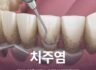 치주염 원인 잇몸치료 어떻게 진행될까?