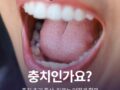초기 충치 증상, 치료는 어떻게 할까?