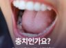 초기 충치 증상, 치료는 어떻게 할까?