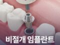 비절개임플란트 가능할까?