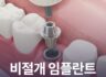 비절개임플란트 가능할까?