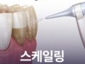 스케일링 한번도 안 했는데, 꼭 해야 할까요?