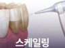 스케일링 한번도 안 했는데, 꼭 해야 할까요?