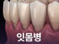 잇몸병 방치하면 안 될까?