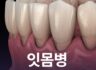 잇몸병 방치하면 안 될까?