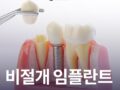 비절개 임플란트 할 수 있을까?