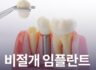 비절개 임플란트 할 수 있을까?