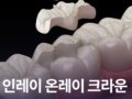 인레이 온레이 크라운 어떤 차이가 있나요?