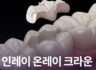 인레이 온레이 크라운 어떤 차이가 있나요?