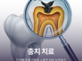 충치 치료, 단계별 맞춤 진료로 소중한 치아 보존하기