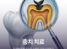 충치 치료, 단계별 맞춤 진료로 소중한 치아 보존하기