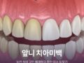 앞니 치아미백, 누런 치아 고민 해결하고 환한 미소 되찾기