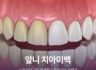 앞니 치아미백, 누런 치아 고민 해결하고 환한 미소 되찾기