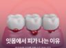 잇몸에서 피가 나는 이유, 방치하면 치아를 잃을 수도 있습니다!